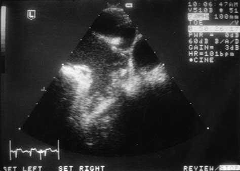 Left atrial appendage: structure, function, and role in thromboembolism | Heart
