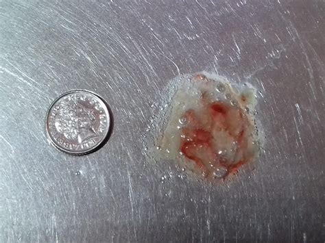 Cough Chest Pain Green Mucus at Isaac Macquarie blog