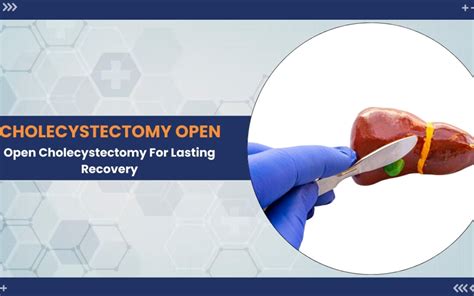 Open Cholecystectomy 的图像结果
