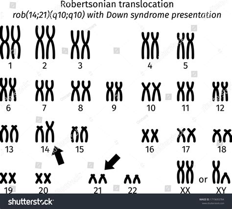 Robertsonian Translocation Karyotype