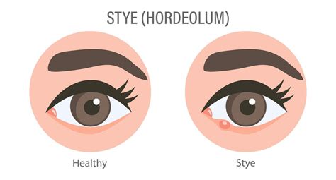 External and internal stye of the eye. Medical concept of stye, eye pain, bacterial infection ...