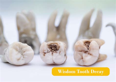 Wisdom Teeth Extractions | Langley Surgery | Lighthouse Dental