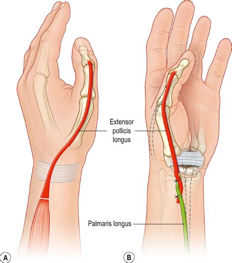 Tendon transfers - Clinical Tree