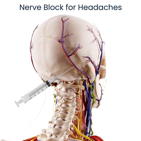 Nerve Block Injections in NYC | Nerve Block for Headaches New York