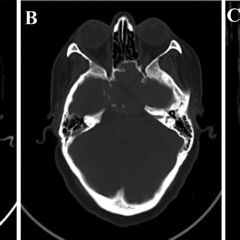 Brain CT Scan 的图像结果