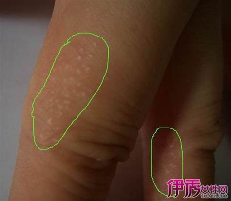 【手指真菌感染】【图】手指真菌感染症状是什么 3大治疗手指真菌感染的方法(2)_伊秀健康|yxlady.com