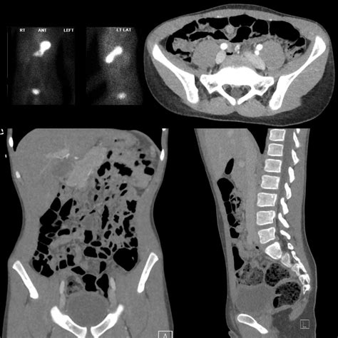 Meckel Diverticulum | Pediatric Radiology Reference Article | Pediatric Imaging | @pedsimaging
