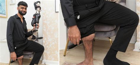 UK Man's Foot Connected Backwards