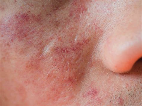 Eczema on the Face: Symptoms, Causes, Diagnosis, Treatment