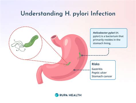 How to Use An H Pylori Test to Diagnose and Treat