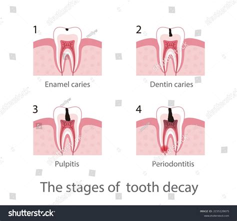 Stages Of Tooth Decay: Over 332 Royalty-Free Licensable Stock Vectors & Vector Art | Shutterstock