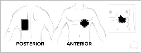Anteroposterior Aed Placement