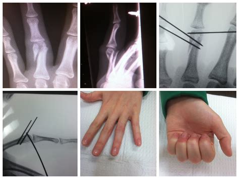 Finger Fracture Treatment with Percutaneous Pins - John Erickson, MD