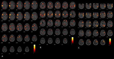 Image result for Language Mapping Awake