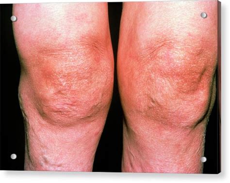 Rheumatoid Arthritis In Knees Photograph by Science Photo Library