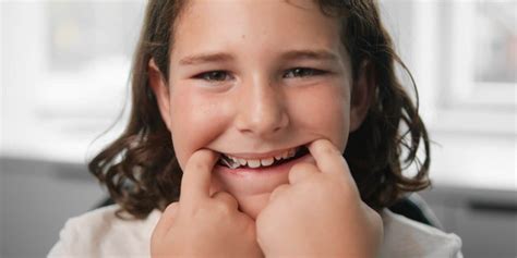 Invisalign Expander 的图像结果