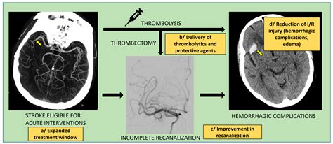Nanotechnology in Stroke: New Trails with Smaller Scales