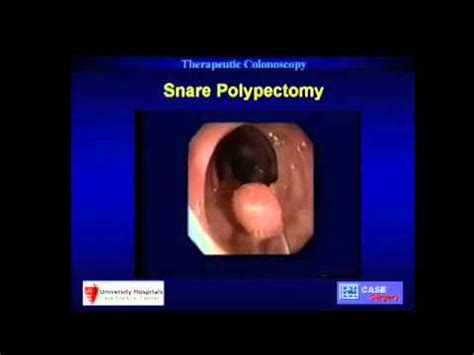 Image result for Colonoscopy Polypectomy
