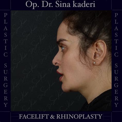 Deep Plane Facelift and Closed Piezo Rhinoplasty: Redefining the ...