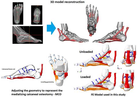 Biomechanical Effects of Medializing Calcaneal Osteotomy on Bones and ...