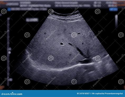 Normal Liver Ultrasound