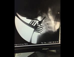 Dr. Vinod Gautam - Chipper Price For Spine Operation Doctor, Spine ...