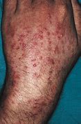 Image result for pustulosis