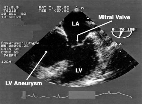 Massive Left Ventricular Aneurysm | Circulation