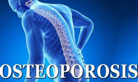 Vertebral fracture assessment useful predictor of osteoporosis in ...