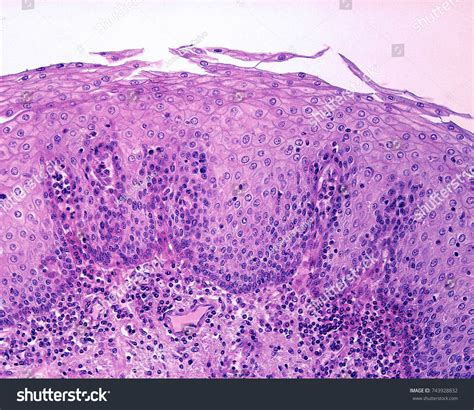 Keratinized Vs Non Keratinized Stratified Squamous Epithelium