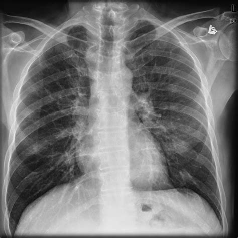 Chest X Ray Showing Acute Bronchitis at Darrel Ferreira blog