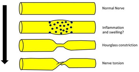 Neuralgic Amyotrophy and Hourglass Nerve Constriction/Nerve Torsion ...