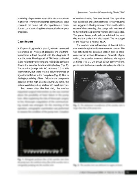 SOLUTION: Spontaneous cessation of communicating flow in a twin ...