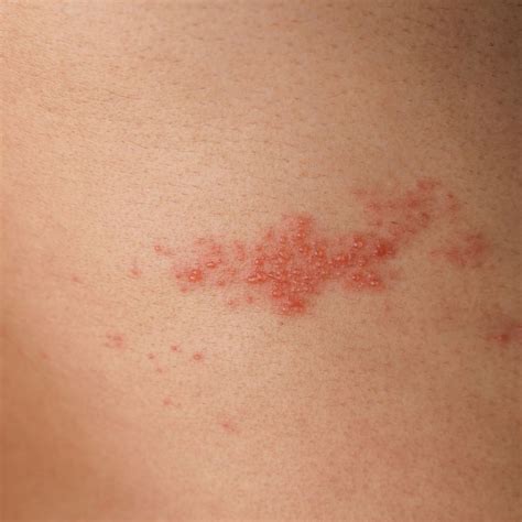 Varicella-zoster-Infektionen während krankheitsmodifizierender MS-Ther ...