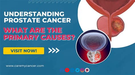 Understanding Prostate Cancer: What Are the Primary Causes?