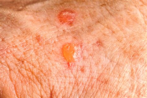 Actinic Keratosis Treatment | U.S. Dermatology Partners