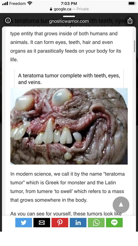 A teratoma Tumor complete with teeth, eyes and veins | Scrolller