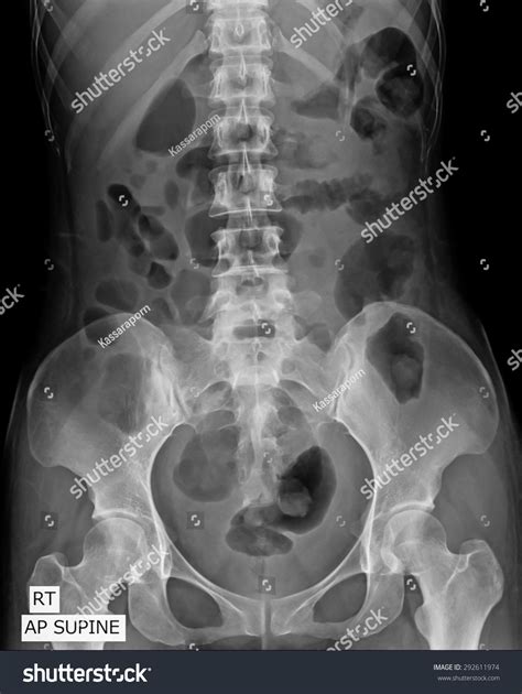 Labeled Abdominal X Ray