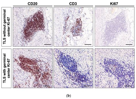 A Mature Tertiary Lymphoid Structure with a Ki-67-Positive ...