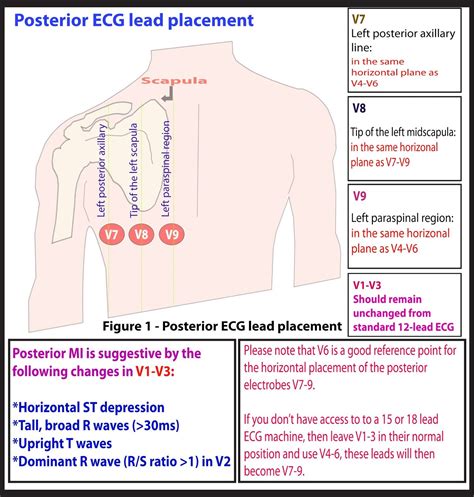 Posterior EKG lead placement | Ekg placement, Nursing notes, 12 lead ...