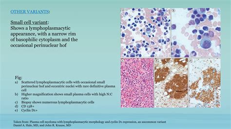 PLASMA CELL DYSCRASIAS Overview.....pptx
