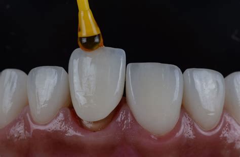 Which Dental Crown Is Best For Front Teeth at Sheila Sparks blog