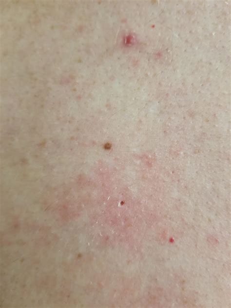 Image result for Exploding Back Zits