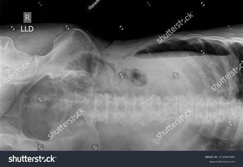 18 Left Decubitus Images, Stock Photos & Vectors | Shutterstock
