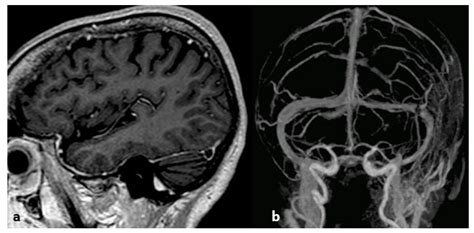 Superior Sagittal Sinus Thrombosis