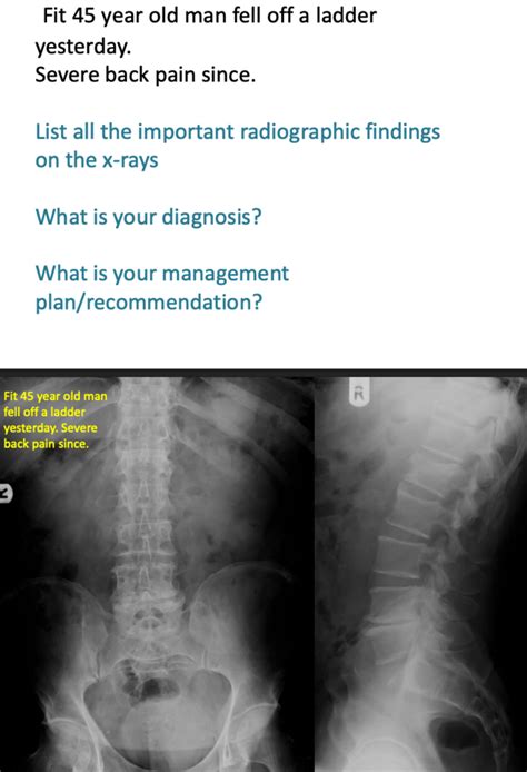 Image result for Compression Fracture Step Defect