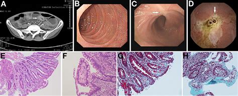 Chronic Diarrhea And Rapid Weight Loss at Lola Goll blog
