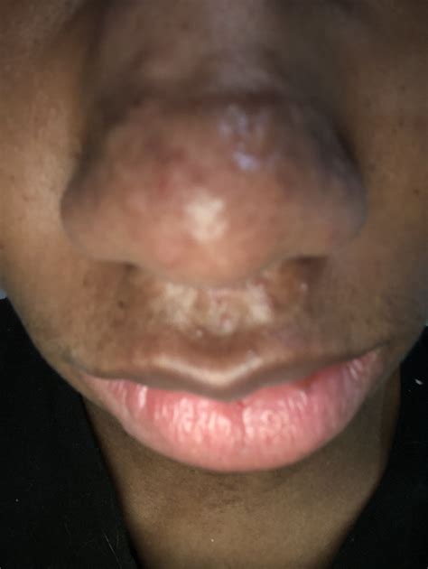 Raised Hypertrophic Nose Acne Scars. Help me plzzz - Hypertrophic (raised) scars - Acne.org