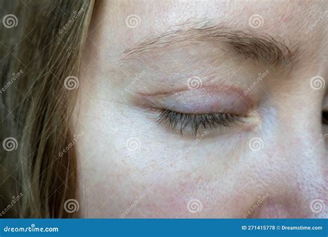 Woman Face after Plastic Surgery on Eyes, Blepharoplasty Operation, Incisions Stitches, Healing ...