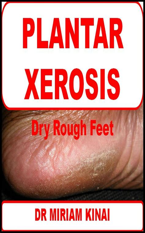 Dermatology: Plantar Xerosis (Skin Diseases Book 37) eBook : Kinai, Dr ...